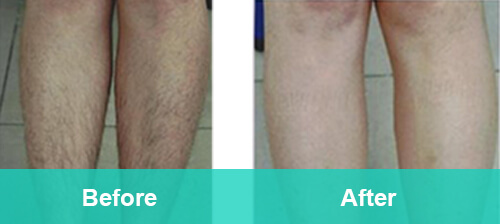 Leg Hair Removal