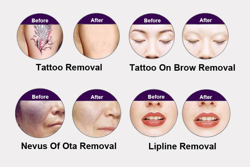 Laser Tattoo Removal MachineApplications