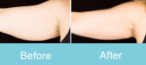 Arm Slimming Treatment