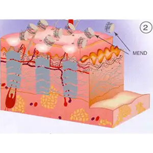 Collagen remodeling takes place in the Microthermal Treatment Zone, and a small plug of MicroEpidermal Necrotic Debris (MEND) flakes off in a few days.