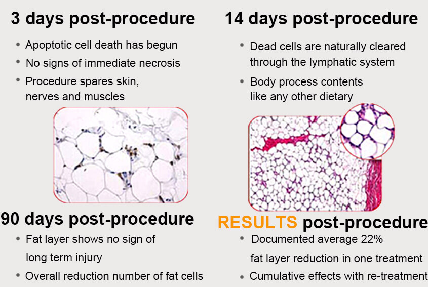 Fat Freezing