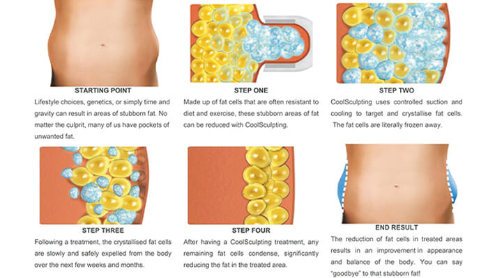 Cryolipolysis Fat Freezing Treatment