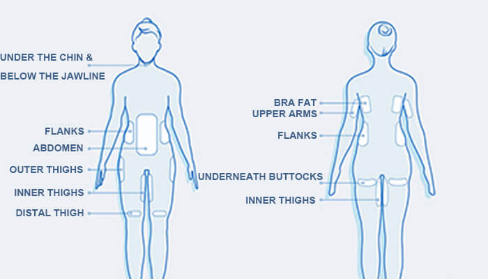 Cryolipolysis Treatment Areas