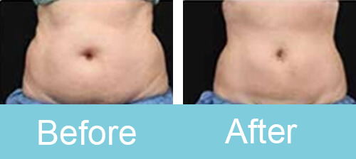 Cryolipolysis_treatment_before_after_photos_2