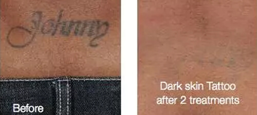Dark Skin Tattoo After Two Laser Tattoo Removal Treatments