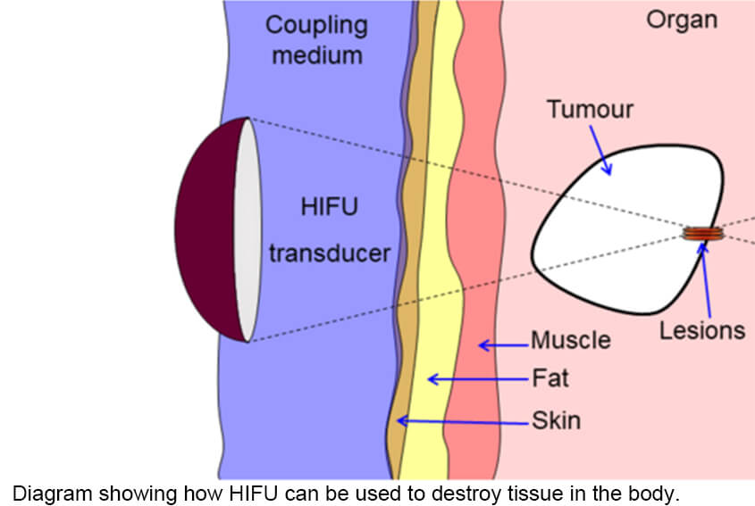 Diagram showing how HIFU can be used to destroy tissue in the body. An acoustic lens is used to focus sound to a small point in the body. The sound propagates through many layers of tissue. Because of the focal gain, only tissue at the focus is destroyed.