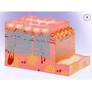 Each treatment session covers about 20% of the skin surface. Usually 4~6 treatments spaced at 1 week intervals are needed.