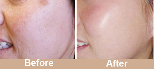 Facial Pigmentation Treatment Before After Photos