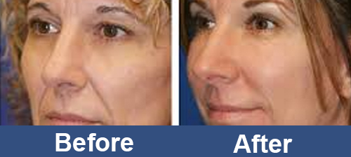 Facial_RF_Skin_Rejuvenation