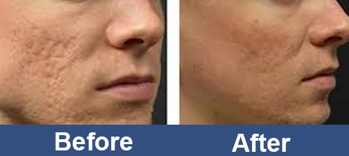 Facial_RF_Skin_Rejuvenation_For_man