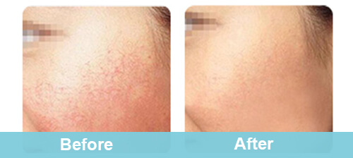 Professional Facial Spider Veins Removal Treatment