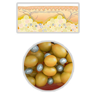 Following the treatemnt, fat cells reach an biological death and removed by metabolism process.