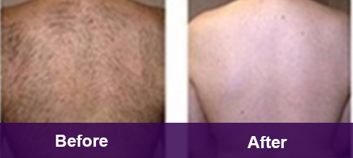 Full Back Hair Removal