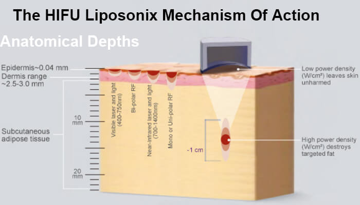 HIFU Fat Removal Principle