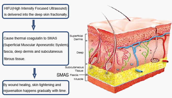 HIFU Skin Tightening Principle