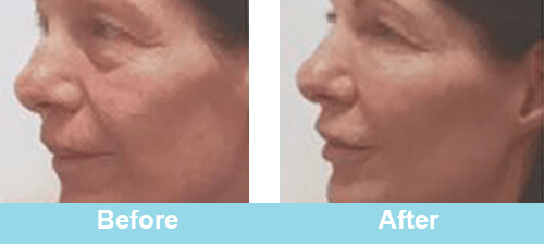 HIFU Face Treatment Before After Photos