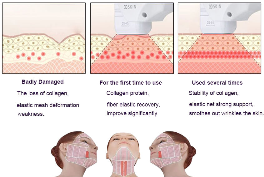 HIFU Facelift