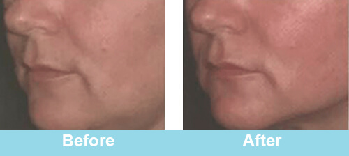 HIFU Face Treatment Before After Photos