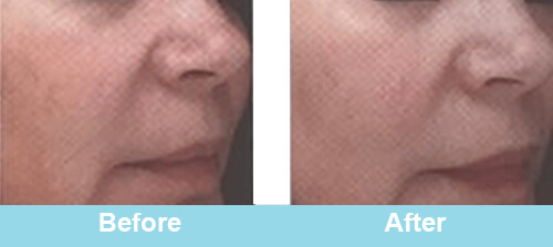 HIFU Face Treatment Before After Photos
