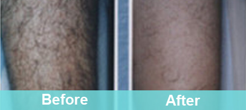 Leg Hair Removal