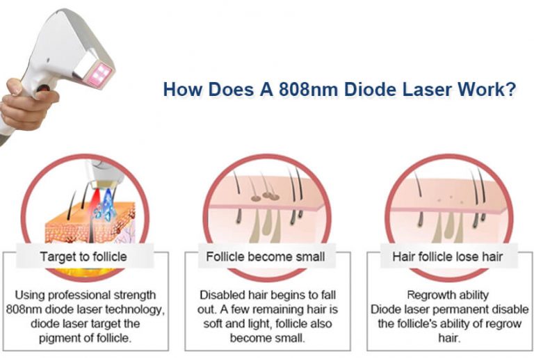Diode Laser Semiconductor Technology for Hair Reduction PrettyLasers