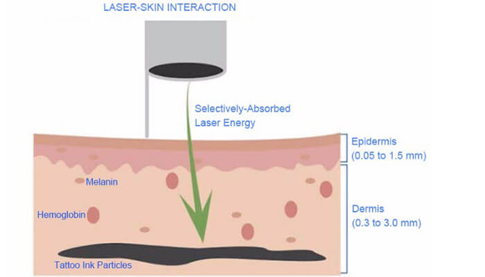 How Does Laser Tattoo Removal Work?