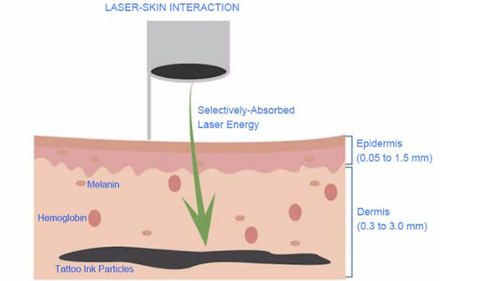 How Does Laser Tattoo Removal Work? How Does Laser Tattoo Removal Work?