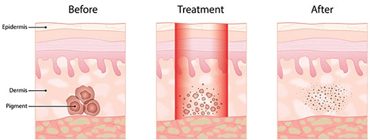 How Does Pigmented Lesion Removal Work?
