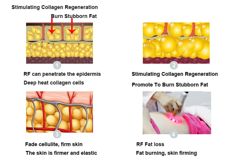 How Does Radiofrequency(RF) Work?