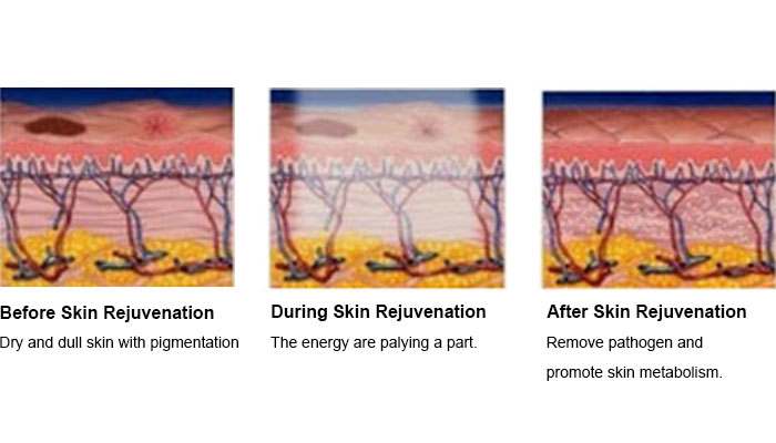 How Does Skin Rejuvenaiton Work?