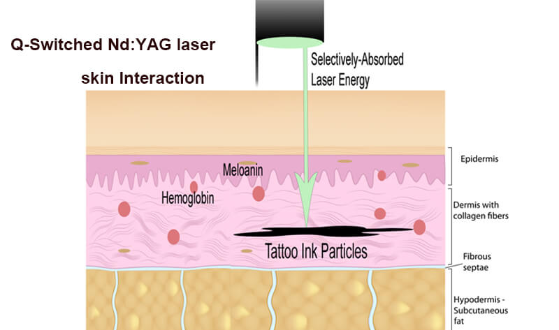 How Laser Tattoo Removal Works?