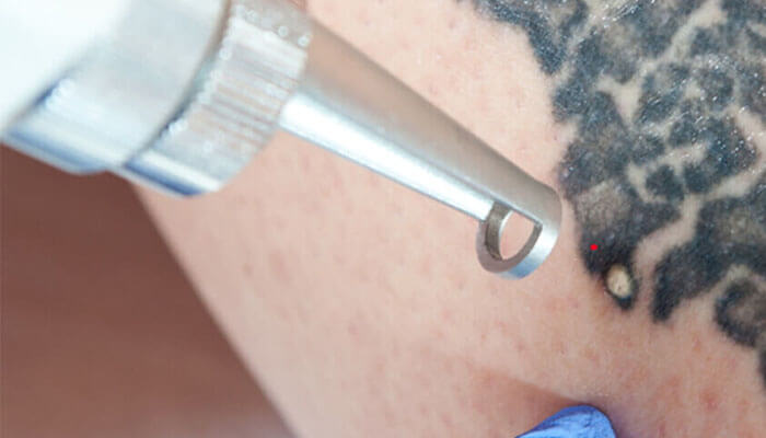 How Often Can I Receive Laser Tattoo Removal Treatment?