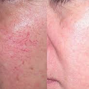 How To Get Rid Of Spider Veins On Face?