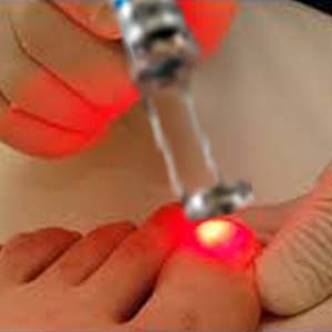 How Does The Laser Toenail Fungus Treatment Work?