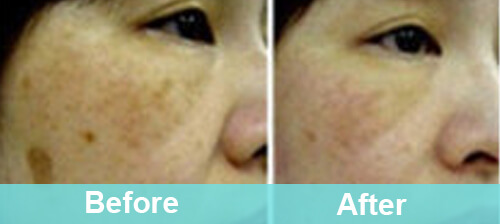 Freckles & Sun Spots Removal