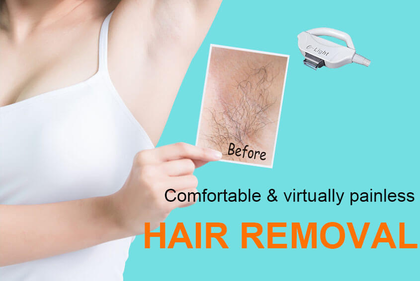 IPL Permanent Hair Removal/Reduction System Supplier PrettyLasers