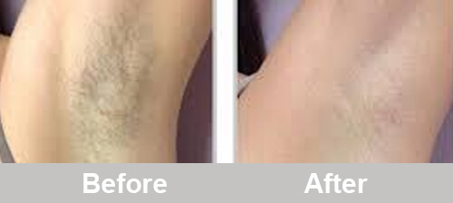 IPL_Hair_Removal_Treatment_Before_After_Photos