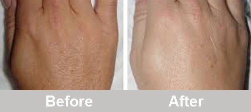 IPL_Hands_Hair_Removal_Treatment_Comparison_Photos