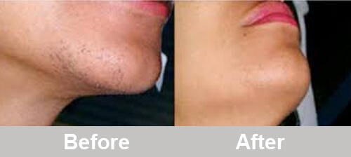 Intense-pulsed-light-for-chin-hair-removal-comparison-before-after-photos