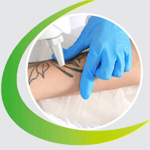 Tattoo Removal