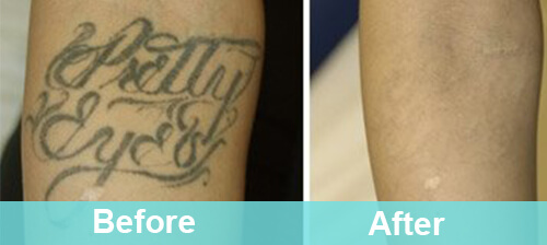 Laser Tattoo Removal Treatment