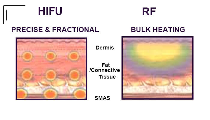 Main Differences Between HIFU And RF