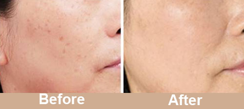 Pigmentation Treatment Real Result