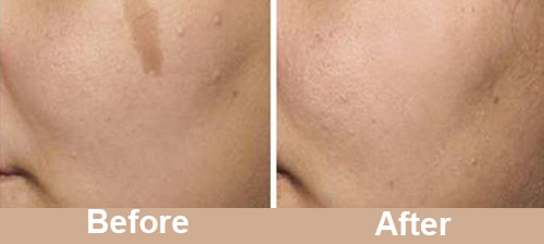 Pigmentation Treatment Before After Photos