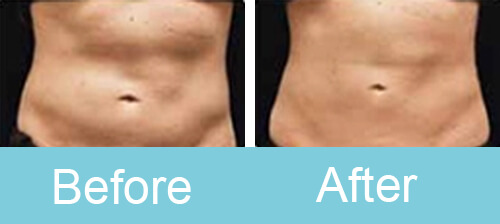 Portable_cryolipolysis_Treatment_before_after_photos