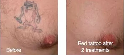 Red Tattoo After Two Laser Tattoo Removal Treatments