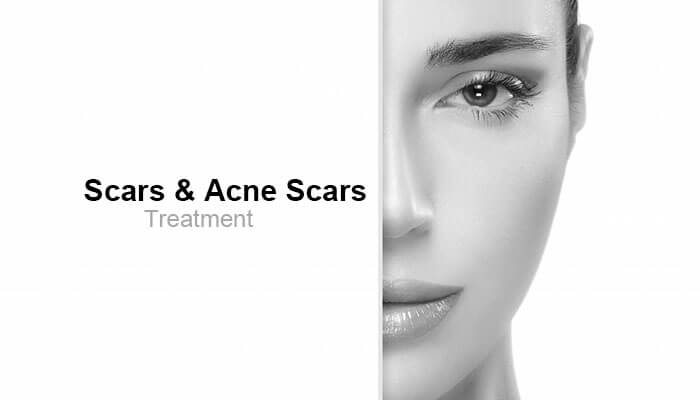 Scars & Acne Scars