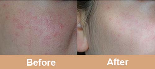 Spider Veins Treatment