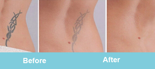 Tattoo Removal Treatment