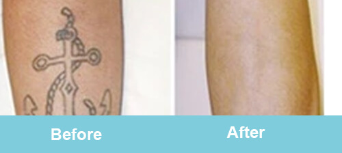 Tattoo Removal Treatment